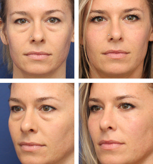 Temporary Eye Tightener