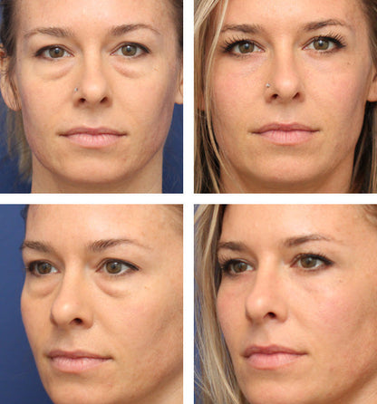 Temporary Eye Tightener